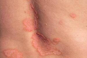 Understanding Psoriasis Through Close-Up Skin Detail Showing the Condition on the Back With Patches and Redness Visible photo