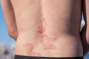 Skin Condition on Back of a Person Showing Symptoms of Psoriasis During Sunny Outdoor Day photo