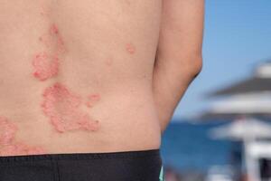 Visible Psoriasis Lesions on a Persons Back Near the Beach During Summer, Highlighting the Skin Condition in a Sunny Outdoor Setting photo
