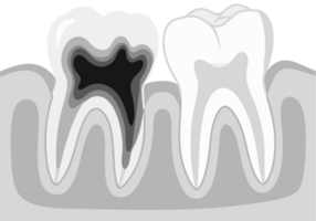 Conceptual Illustration of Dental Health Issues Featuring Decayed Tooth and Cavity as a Representation of Oral Hygiene Challenges and Associated Pain png