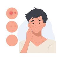 problem skin concept.man with pimples on his face,facial skin troubled. flat cartoon character illustration. vector
