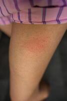 Red swollen spot on womans leg after insect sting or allergic skin reaction photo