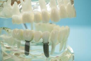 Dental implant, artificial tooth roots into jaw, root canal of dental treatment, gum disease, teeth model for dentist studying photo