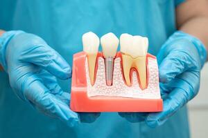 dentist holding dental implant, artificial tooth roots into jaw, root canal of dental treatment gum disease, teeth model for dentist. photo