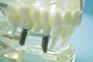 Dental implant artificial tooth roots into jaw, root canal of dental treatment, gum disease, teeth model for dentist studying dentistry. photo