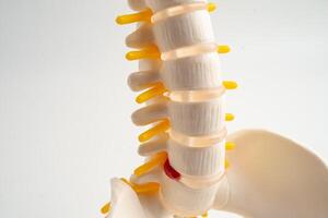 Lumbar spine displaced herniated disc fragment, spinal nerve and bone. Model for treatment medical in orthopedic photo