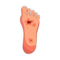 blood vessel clot of leg and diabetic foot vector