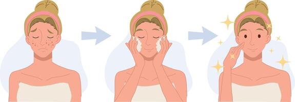 treat acne, skin problem,pimple .woman face.Beautiful.before after,step cleansing face. Flat 2d cartoon character illustration. vector
