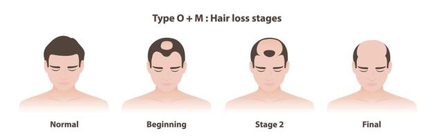 Type O and M hair loss stages in male pattern baldness illustration. Infographic stages of the hairline recedes at the temples, creating a M shape while a round bald patch on the crown of the head. vector