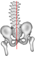 lumbar scoliosis causing uneven hip height png