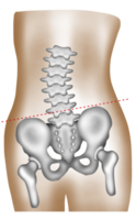 A hand-painted watercolor of lumbar scoliosis causing uneven hip height png