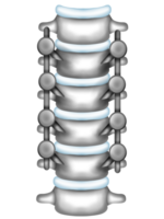 Spine with metal braces png