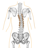 Scoliosis correction surgery using spinal instrumentation png