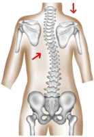 Hand-painted watercolor of a thoracolumbar scoliotic spine causing uneven scapula and shoulder height png