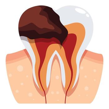 Deep tooth decay affecting enamel, dentin, pulp, and root canal vector