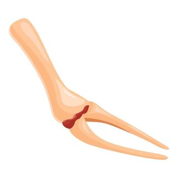 Broken arm bone showing radius and ulna fracture with injury vector