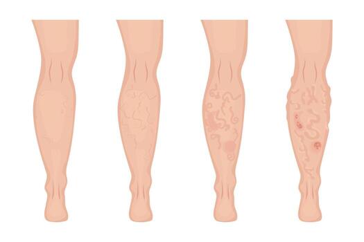 Four steps showing varicose veins gradually appearing on skin, from reticular varicose veins to advanced edema with trophic ulcers, useful for medical and healthcare publications vector