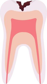 Deep Caries Tooth Problem vector