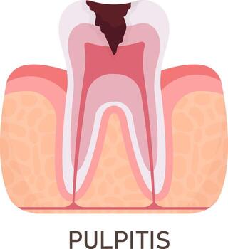 pulpitis diente problema ilustración vector