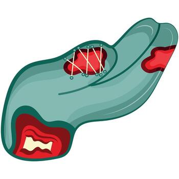 cartoon zombie hand in blue with open wounds and bones that folds into a gesture with an outstretched hand, Halloween design vector