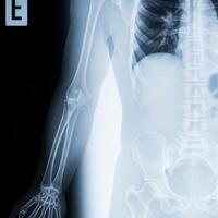detallado radiografía de humano brazo, codo, caja torácica, y columna vertebral, médico formación de imágenes foto