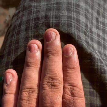 Closeup of Fingernails with vertical ridges photo
