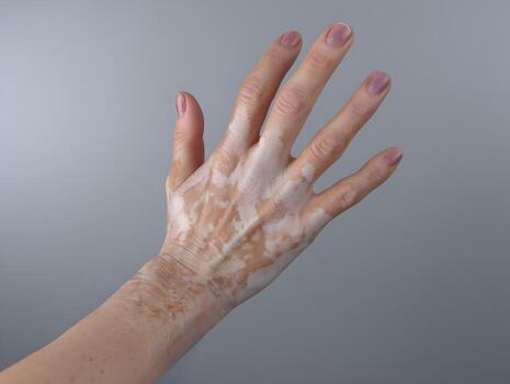 Hand and Forearm with Vitiligo Against a Gray Background. photo