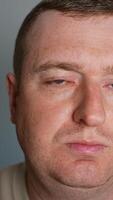 cerca arriba de hombre con rojo ojo comprobación para conjuntivitis video