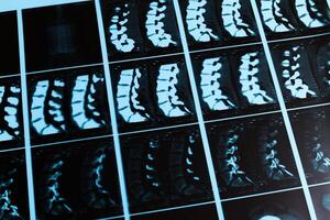 espina mri escaneos desplegado en un caja ligera desde un médico examen en un hospital foto