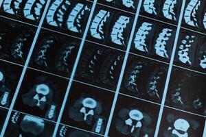 detallado espinal imagen exhibiendo vértebras y intervertebral discos en un clínico ajuste foto