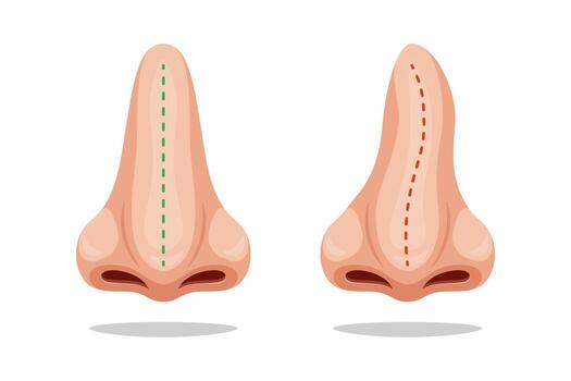 Illustration curve and correct nose, correction nasal curvature. Nose before and after. vector