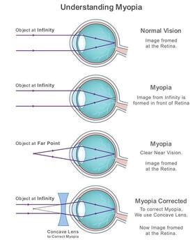 Myopia Explained with Infographic on Normal Vision and Corrective Concave Lens Solutions vector