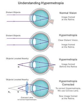 Labeled Diagram Explaining Eye Defect Hypermetropia and Its Image Formation vector