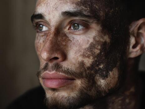 A man with a serious expression looks into the distance, displaying a unique skin pattern on his face. His eyes are intense, and theres a hint of facial hair around his lips photo