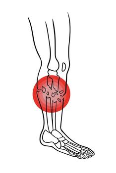 An open fracture of the tibia. X ray of the leg. vector