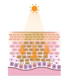 The mechanism of sunspots on skin layer illustration. Cross section of age spots when the skin is exposed to UV rays, the melanin is overproduced, collect into clumps and causing dark spots. vector