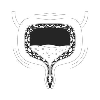 Overactive human bladder with urgency symptom outline illustration. Urinary incontinence, spasms. Trembling walls and urine buildup 2D line object isolated on white. Monochrome ink linear image vector