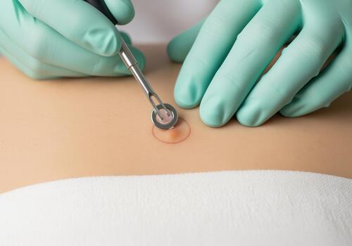 Dermatologist performs skin biopsy with punch tool for tissue sample photo