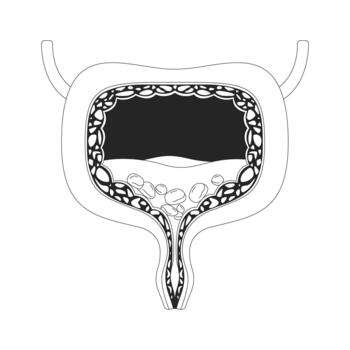 Human bladder cross-section with urinary stones outline illustration. Internal organ blockage. Mineral buildup. Urological issue 2D line object isolated on white. Monochrome ink linear image vector