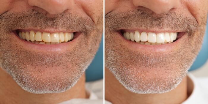 Detailed comparison of dental improvements showing teeth before and after treatment in a clinical setting photo