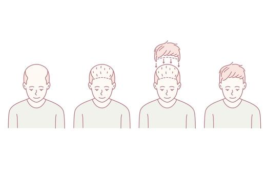 sequential scalp view illustrations, educational depiction of balding to hair restoration journey vector