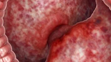 vicino su Visualizza di infiammato intestinale fazzoletto di carta con un' polipo o crescita dentro il colon, in mostra il interno struttura e potenziale medico condizione nel un' realistico 3d animazione. video