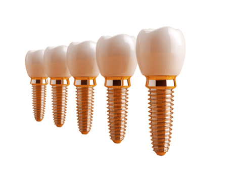 preciso dentale impianti preparativi in mostra Avanzate ricostituente odontoiatria tecnologia e orale png