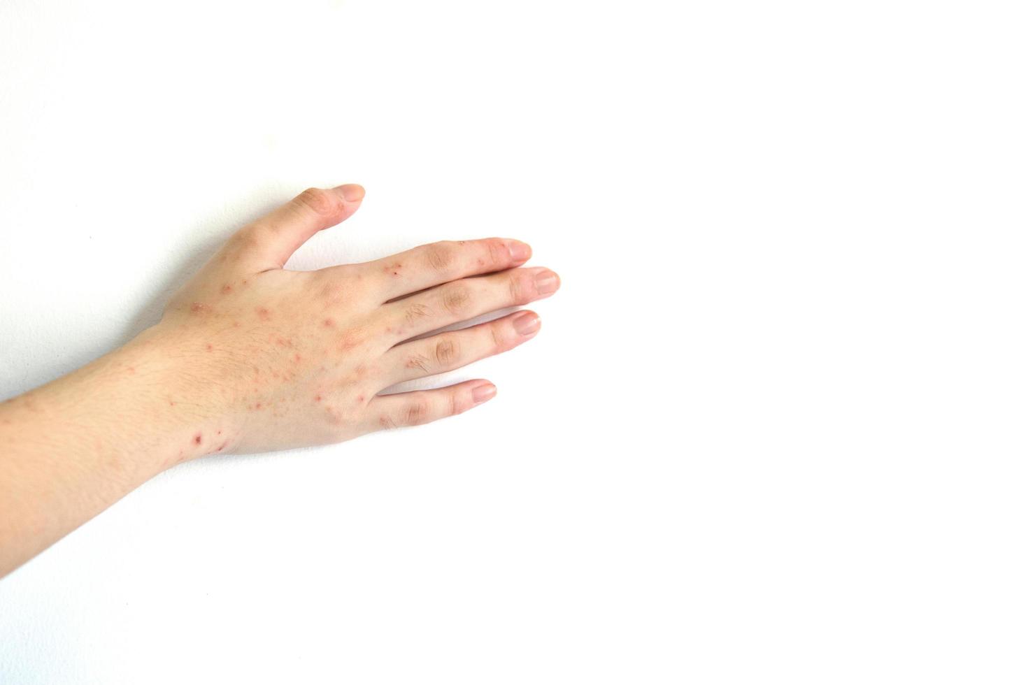 il trattamento per la dermatite atopica, un'infezione e prurito sulla mano di una ragazza comporta la somministrazione di medicinali. foto