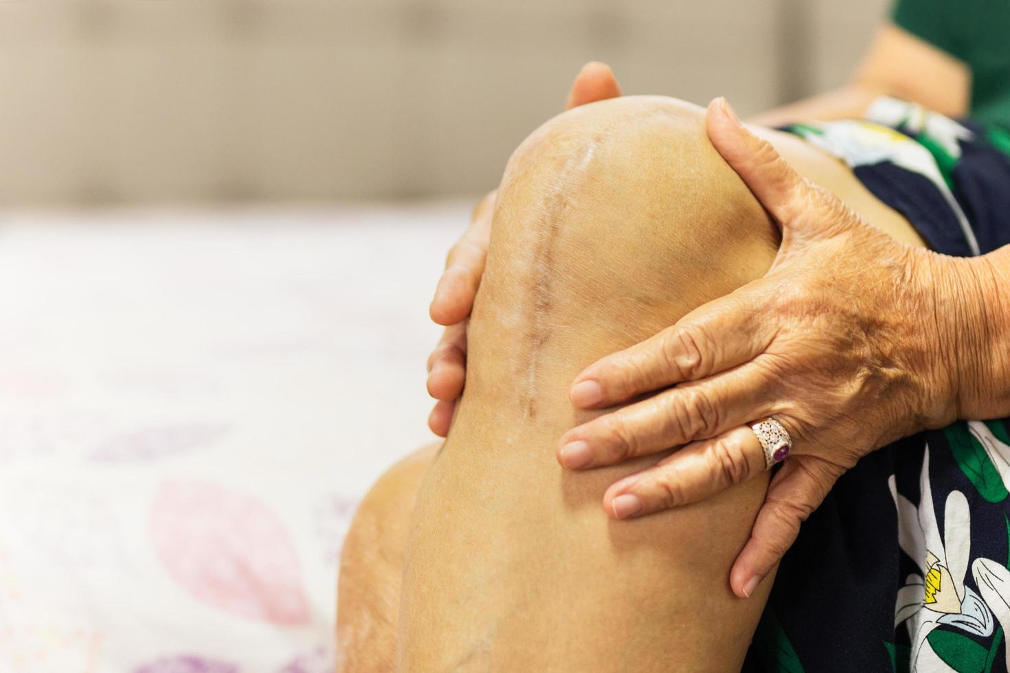 donna anziana mostra il suo intervento chirurgico di sostituzione del ginocchio cicatriziale. foto
