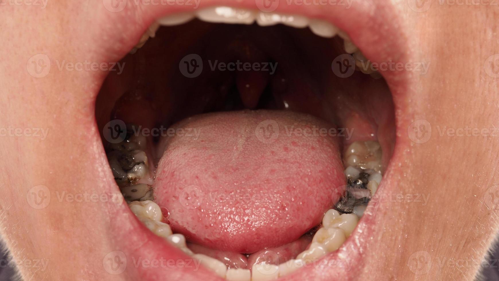 trattamento del canale radicolare del dente cariato. carie del dente o dei denti del molare inferiore. foto