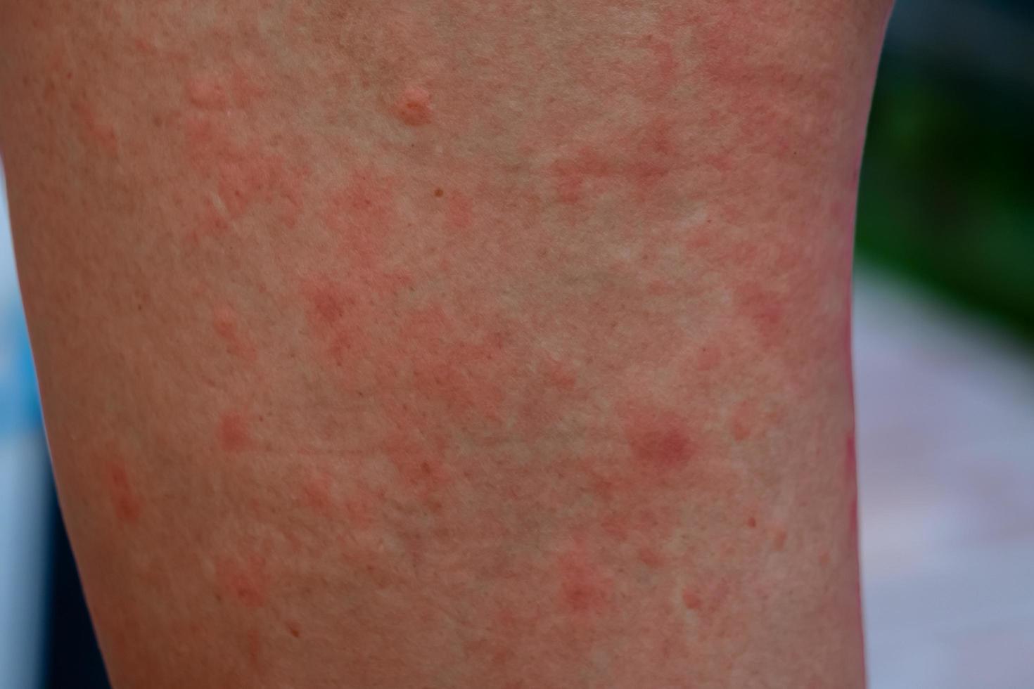 forte allergico eruzioni cutanee su il corpo alterata immunità e reazione per allergenico prodotti. dermatologico eruzione cutanea su il pelle e corpo il problema di Salute e cosmetologia. immune sistema patologia, allergia foto