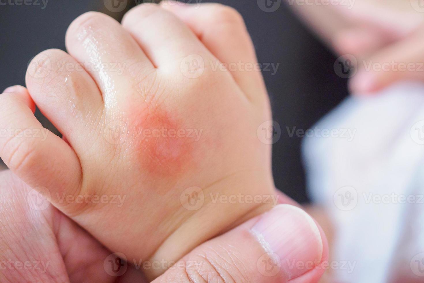 mano del bambino con eruzione cutanea e allergia con macchia rossa causata dalla puntura di zanzara foto