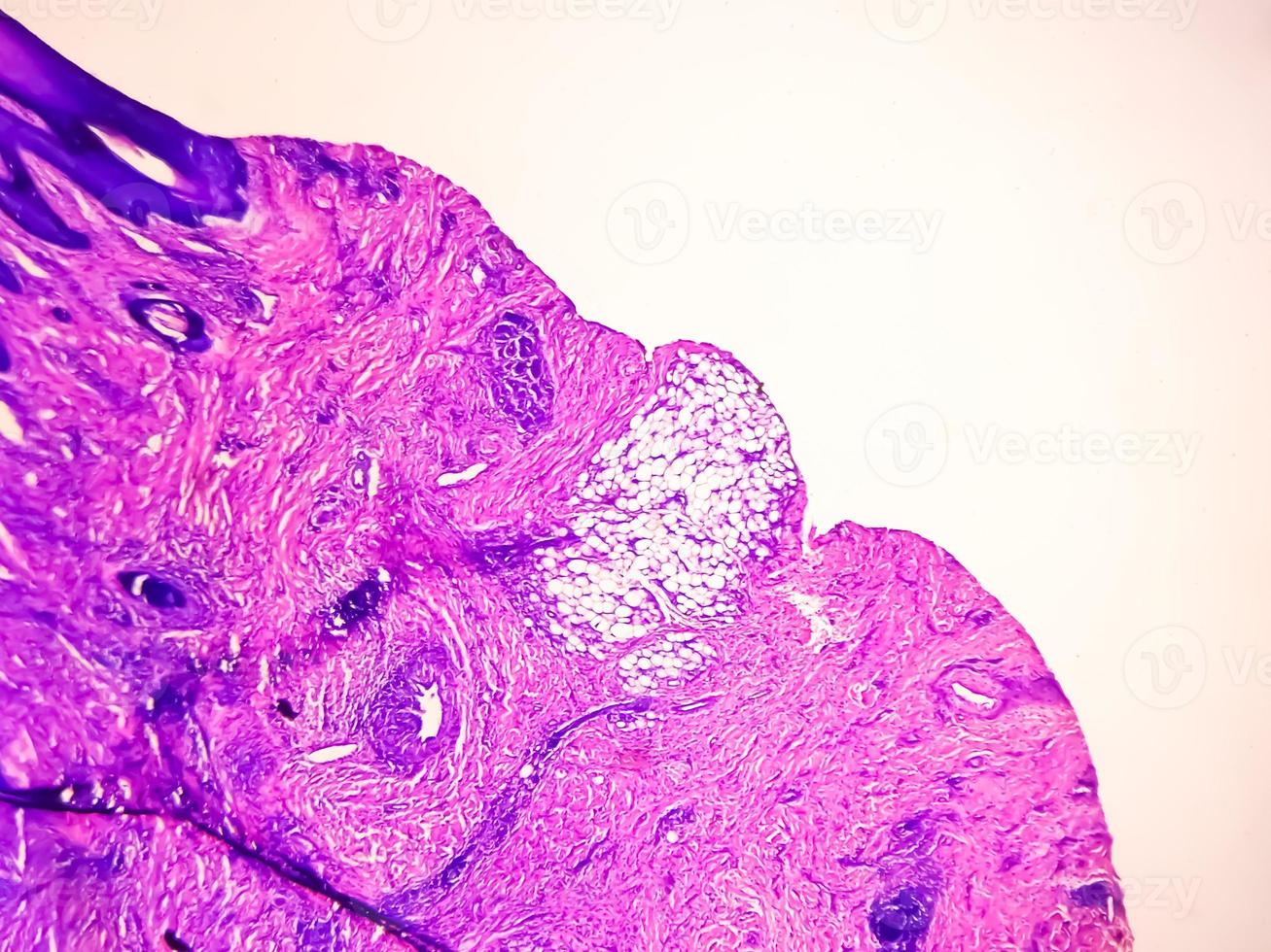 elevato ingrandimento delle cellule della pelle infettate dal virus hpv. verruca comune. verruca volgare. vista microscopica. foto