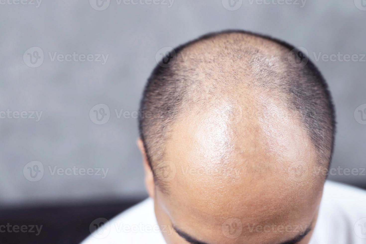 Calvo uomo con capelli i problemi foto